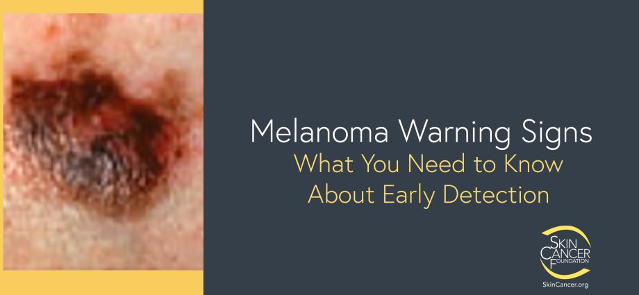 Dermatologist warns: melanoma can develop even in unexpected places