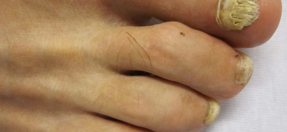 Dermatophyte mycosis of nails &#8211; appearance, causes, treatment