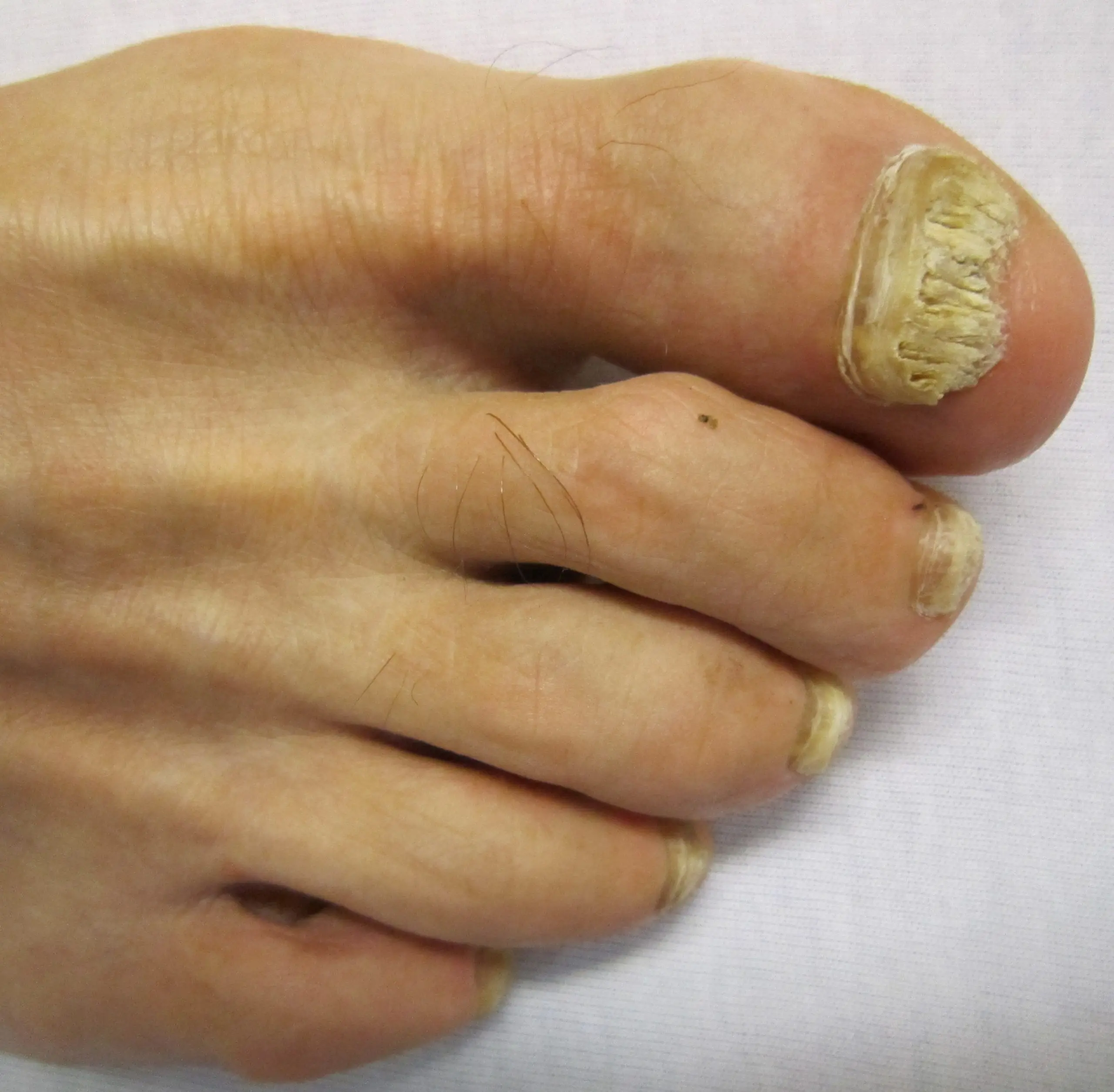 Dermatophyte mycosis of nails &#8211; appearance, causes, treatment