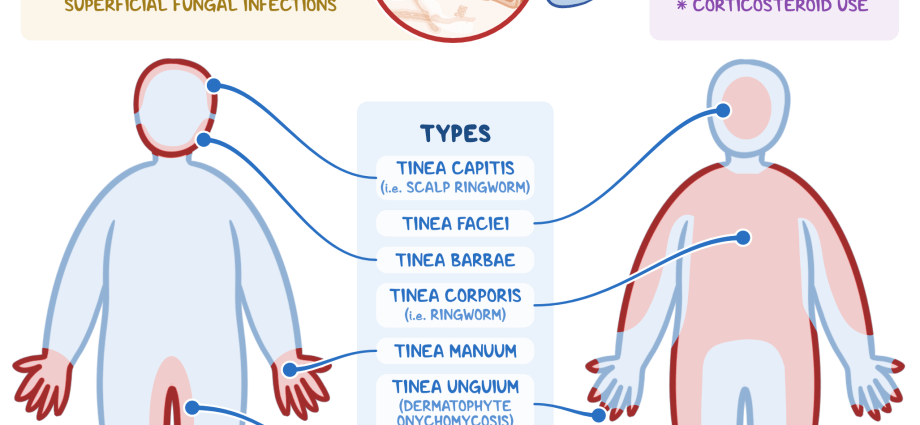 Dermatophytosis – causes, symptoms, treatment – Healthy Food Near Me