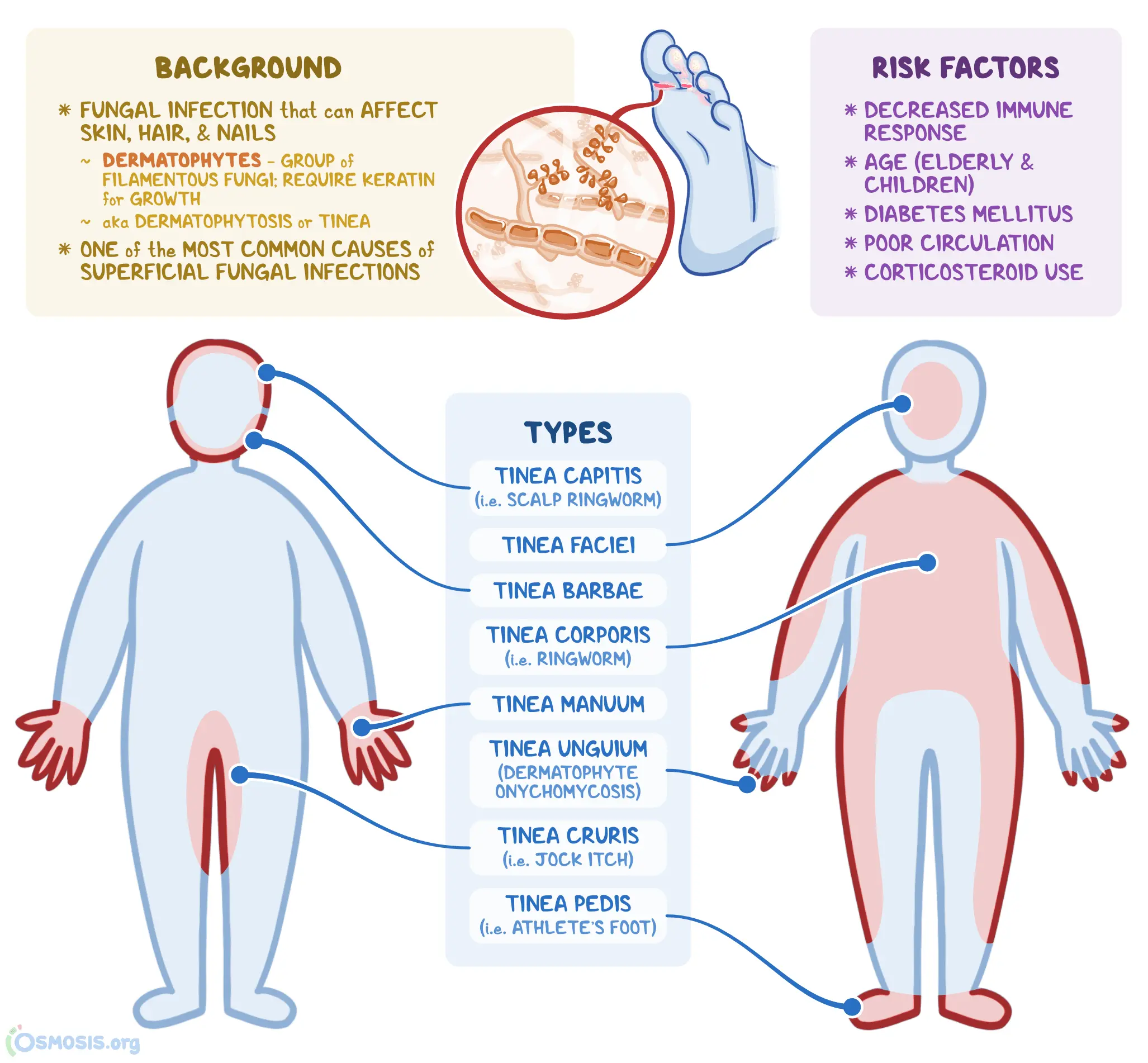 Dermatophytosis &#8211; causes, symptoms, treatment