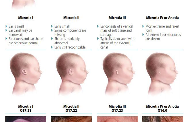 Developmental defects of the auricle &#8211; types and treatment