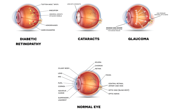 Diabetes can damage your eyesight