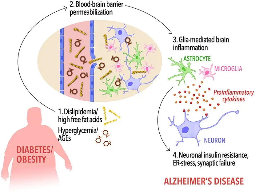 Diabetes is a major risk factor for Alzheimer&#8217;s. What is happening in the patient&#8217;s brain?