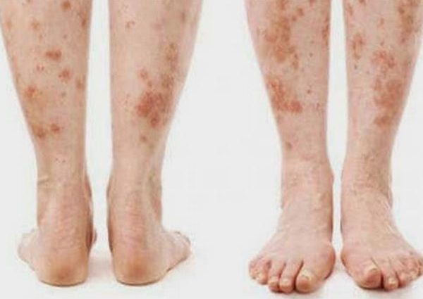 Diabetic dermatopathy &#8211; epidemiology, symptoms, treatment