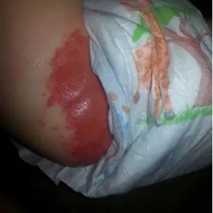 Diaper burns &#8211; causes. Treatment of diaper burns