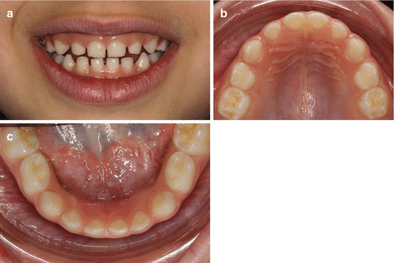 Diastema &#8211; what it is, causes, treatment