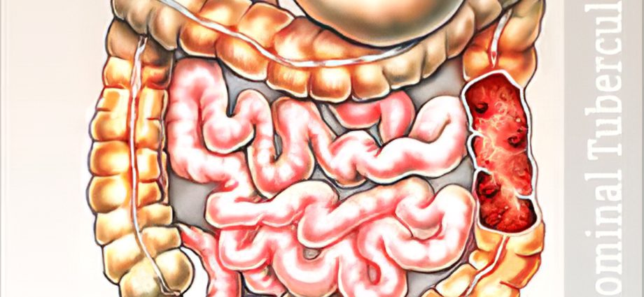 Digestive system tuberculosis