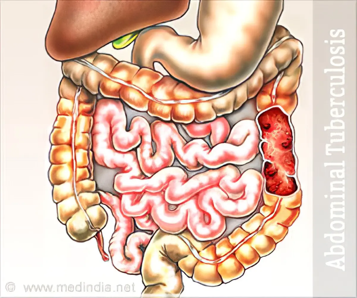 Digestive system tuberculosis