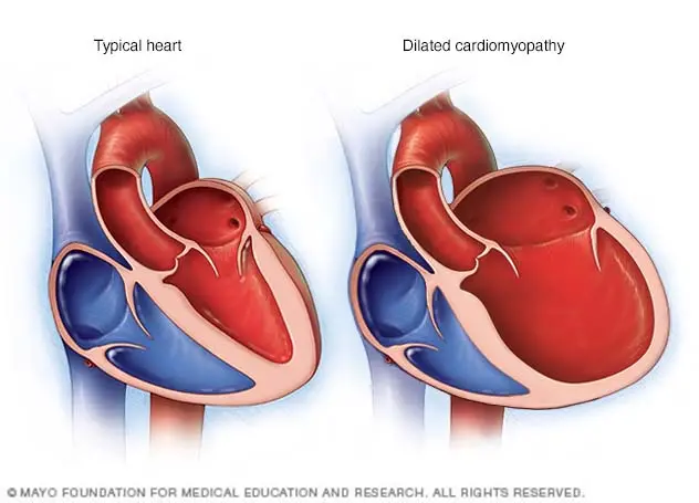 Dilated cardiomyopathy &#8211; what is it?