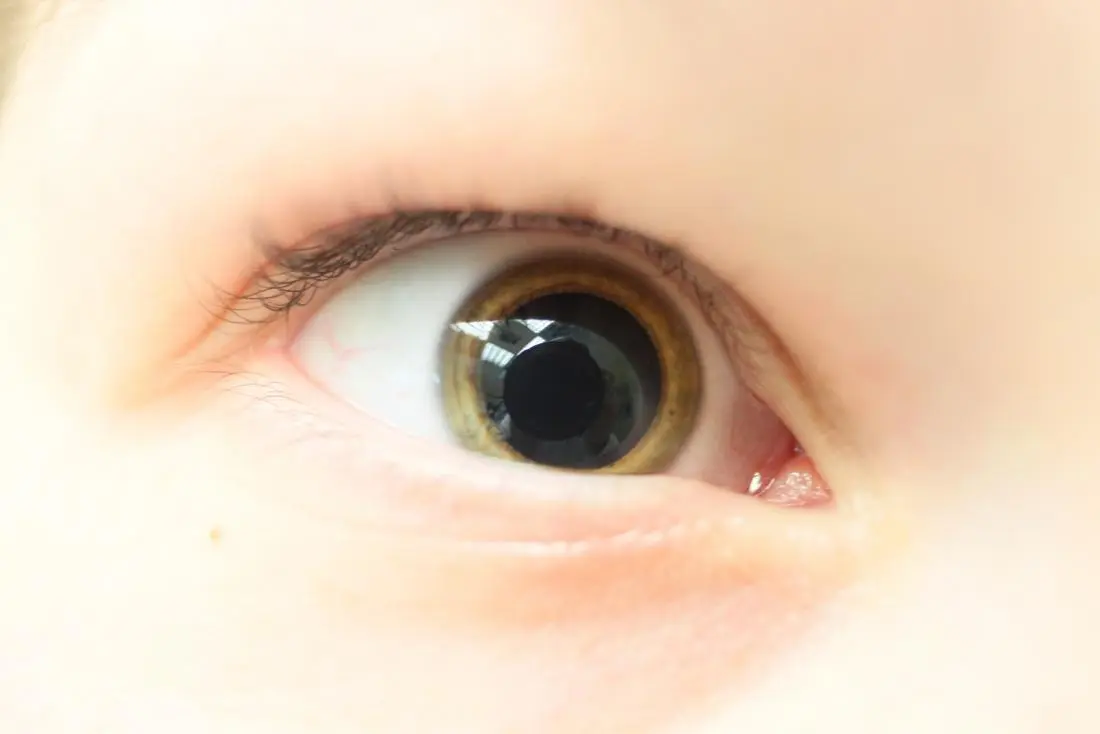 Dilated pupils &#8211; possible causes and what to do in this case