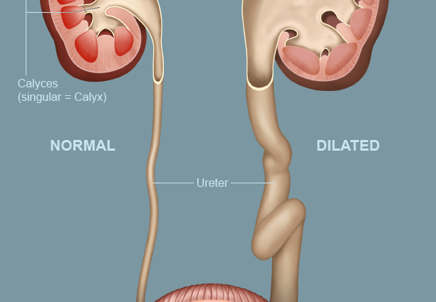 Dilation of the renal pelvis in a newborn &#8211; what is the risk?