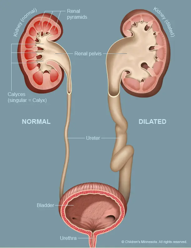 Dilation of the renal pelvis in a newborn &#8211; what is the risk?