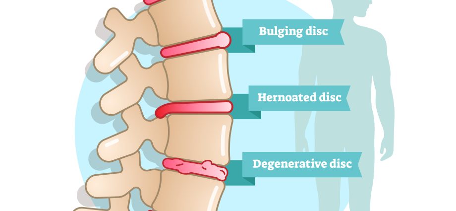 Disc problems in younger and younger people. Treatment of discopathy