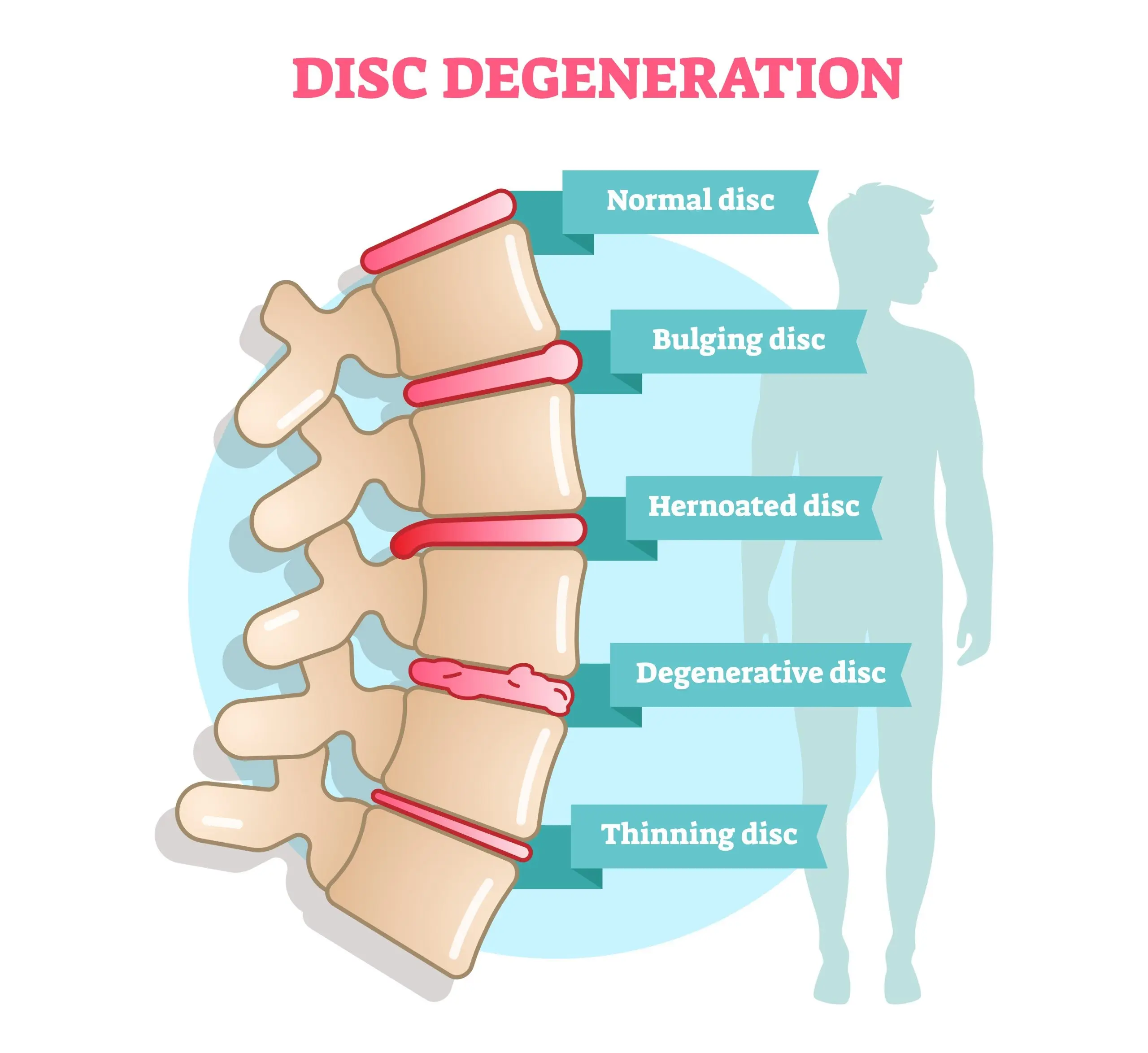 Disc problems in younger and younger people. Treatment of discopathy