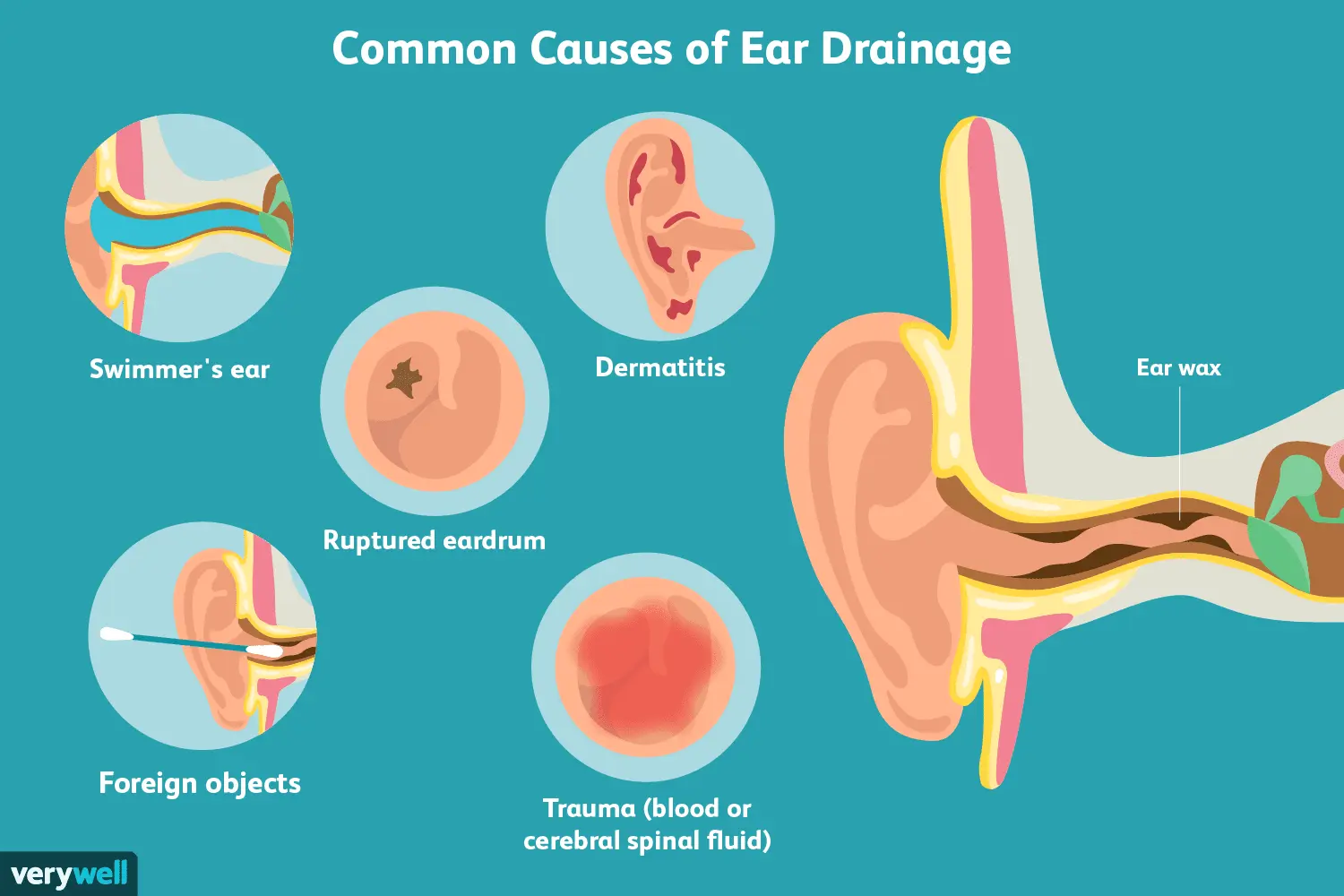 Discharge from the ear &#8211; causes and types. Discharge in the course of otitis