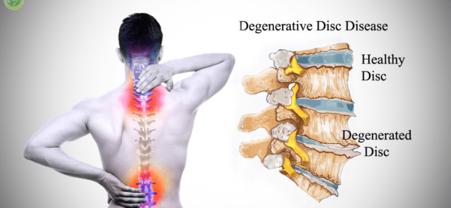 Discopathy &#8211; causes, symptoms, treatment. Cervical, lumbar and thoracic discopathy