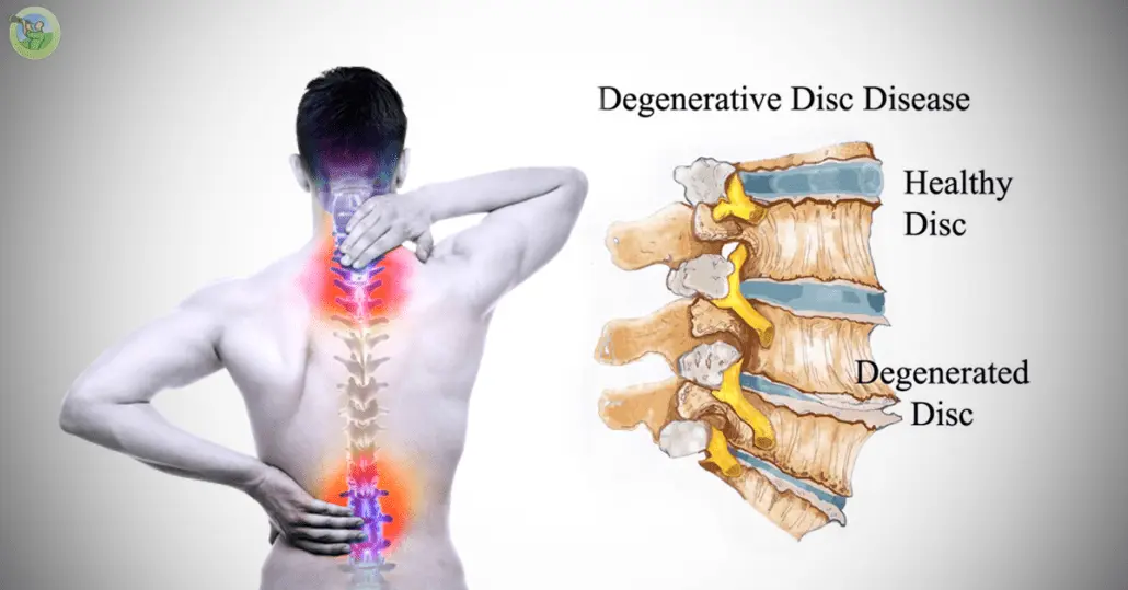 Discopathy &#8211; causes, symptoms, treatment. Cervical, lumbar and thoracic discopathy