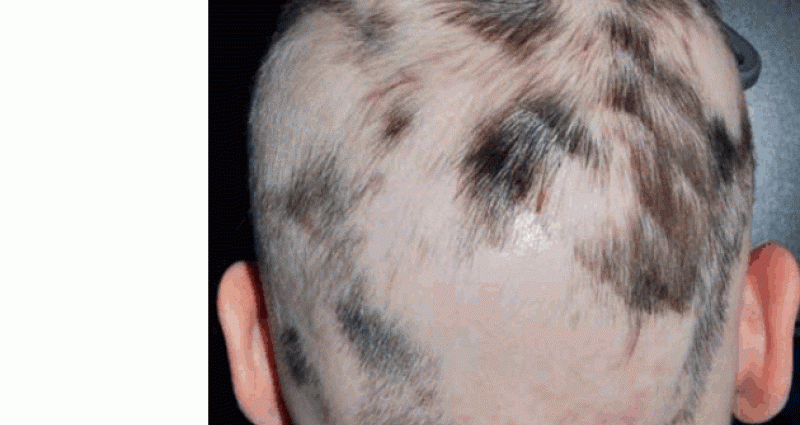 Diseases of the scalp. Alopecia areata, androgenic, hirsutism