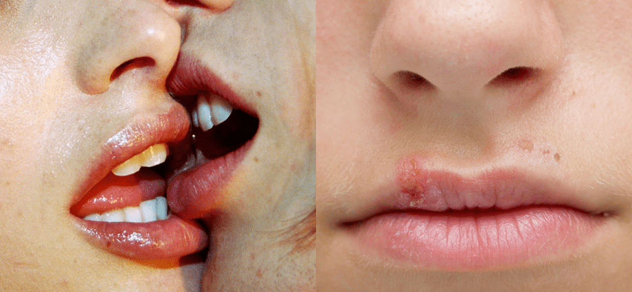 Diseases that you can catch from a kiss. How to protect yourself from them?