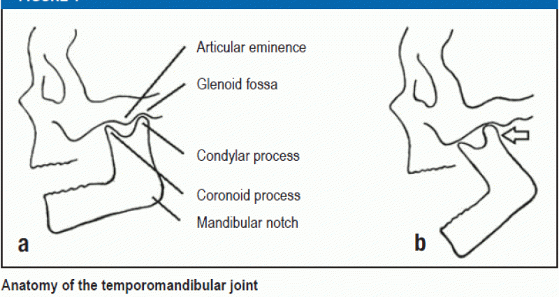 Dislocation of the mandibular joint