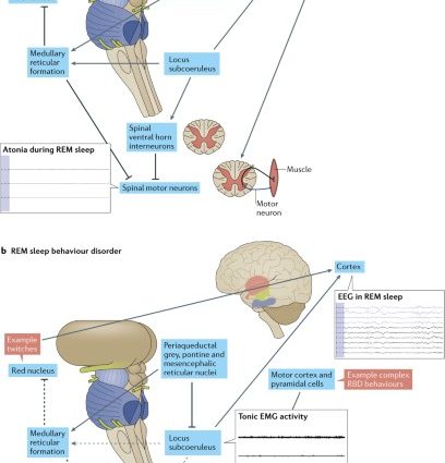 Disturbances in REM sleep phase herald dementia and parkinsonism