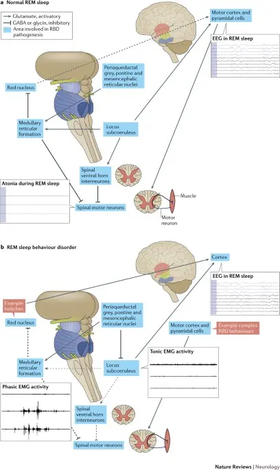 Disturbances in REM sleep phase herald dementia and parkinsonism