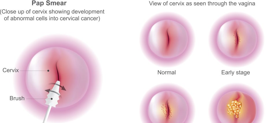 Disturbing Pap smear results &#8211; what does it mean?