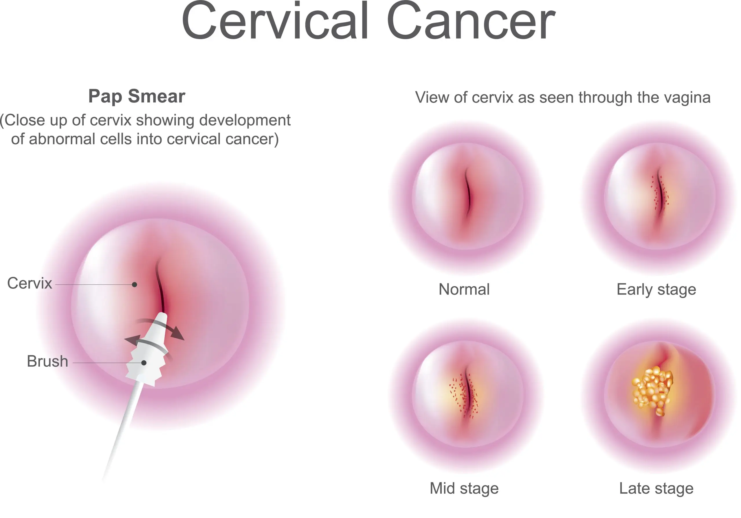 Disturbing Pap smear results &#8211; what does it mean?