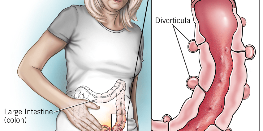 Diverticula of the gastrointestinal tract &#8211; symptoms and diagnosis