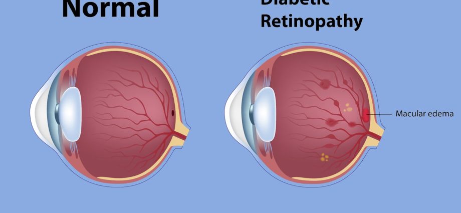 DME &#8211; Diabetic macular edema