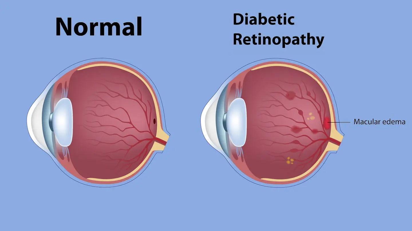 DME &#8211; Diabetic macular edema