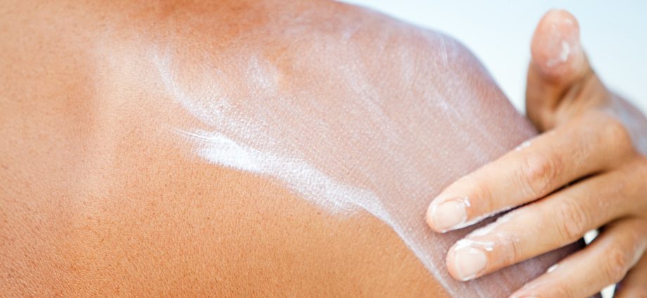 Do you grease a sunburn with butter? You will feel a chill, but it will get worse after that