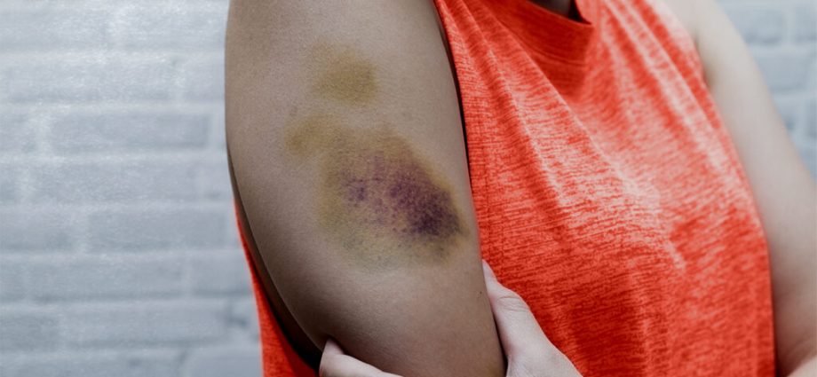 Do you have bruises on your body? You may have one of these diseases