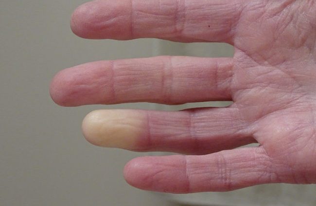 Do you have cold hands and feet? This could be a harbinger of more serious problems