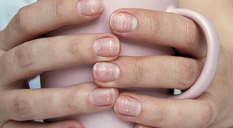 Do you have such nails? These lines could be a symptom of COVID-19