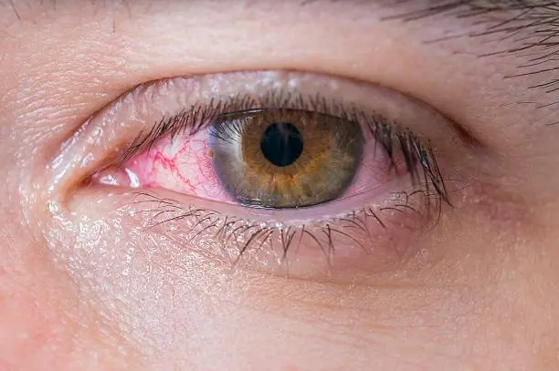 Do your eyes hurt? This could be a symptom of COVID-19