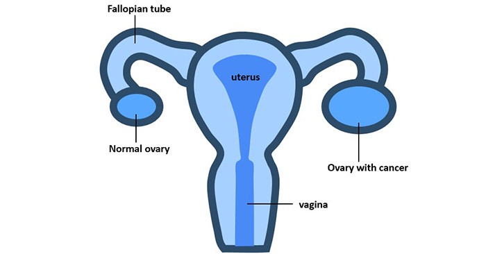 Doctors call him a &#8220;silent killer&#8221;. Ovarian cancer takes almost 3 each year. Polish women