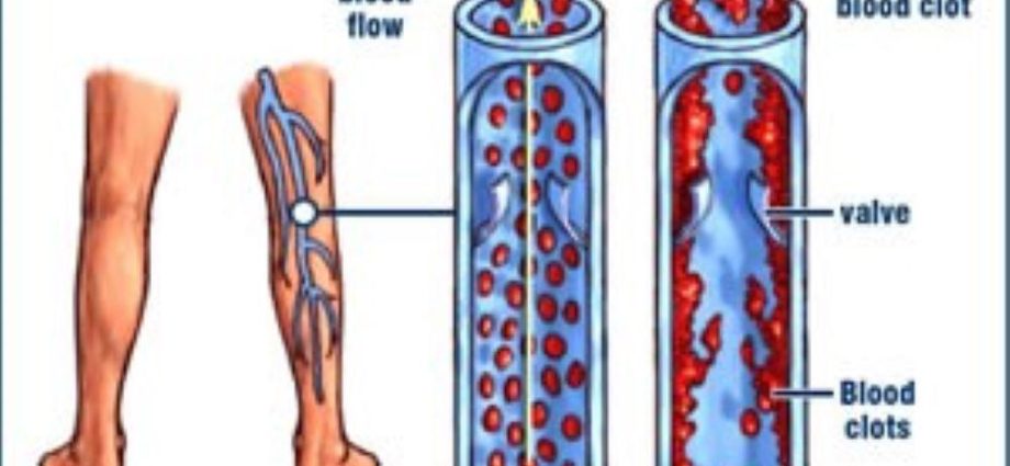 Doctors: Thrombosis is a sneaky killer