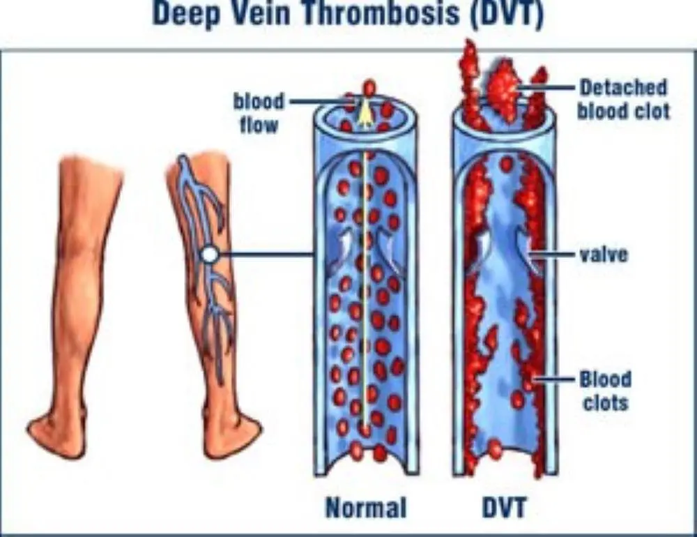 Doctors: Thrombosis is a sneaky killer