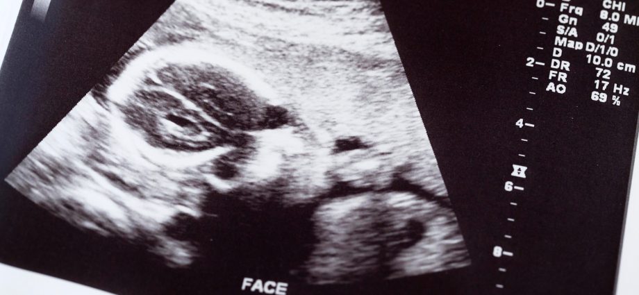 Doctors waited three days for the fetus to die. «Sorry it took us so long»