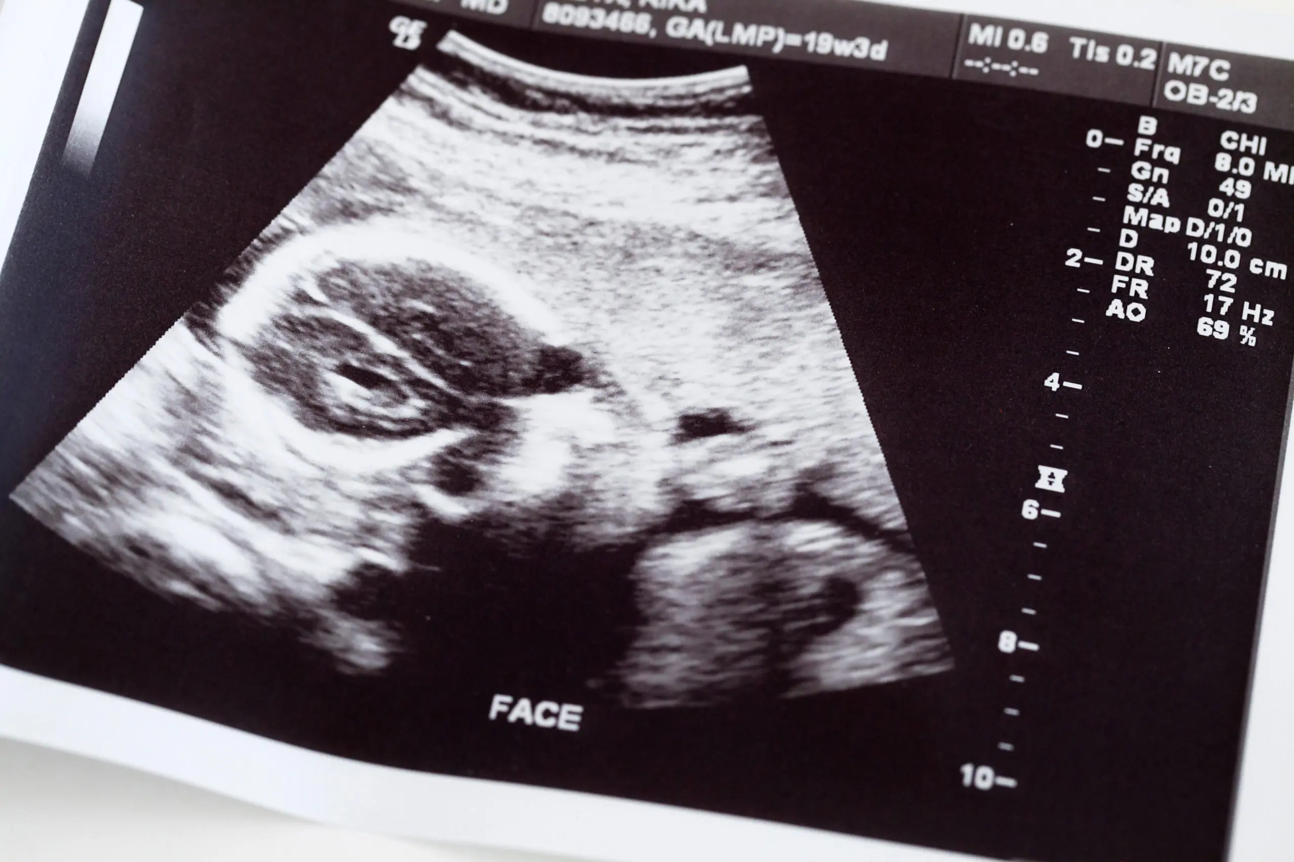 Doctors waited three days for the fetus to die. «Sorry it took us so long»