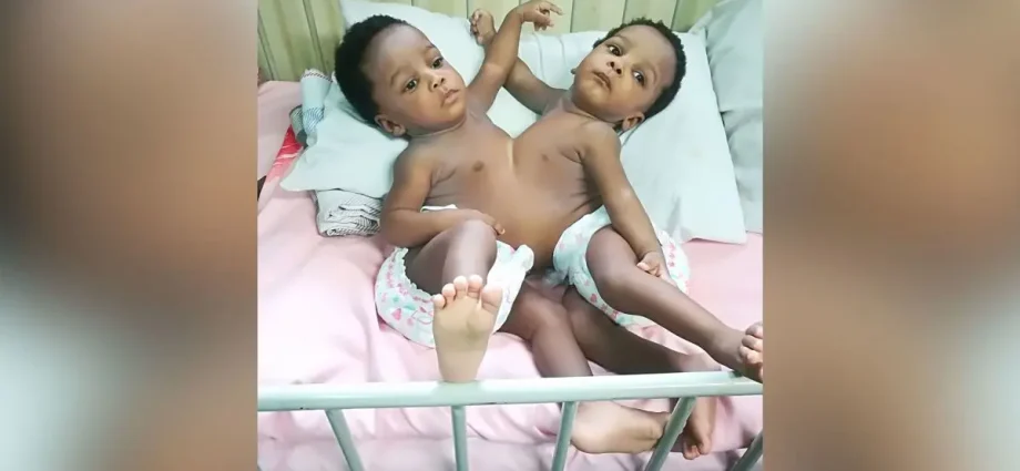 Doctors will operate on Siamese twins. The girls are clumped together with their bellies