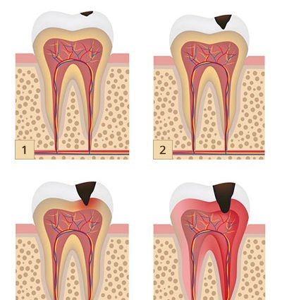 Does a toothache after filling a tooth mean something is wrong?