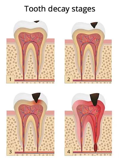 Does a toothache after filling a tooth mean something is wrong?