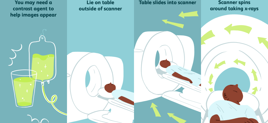 Does contrast tomography have side effects?