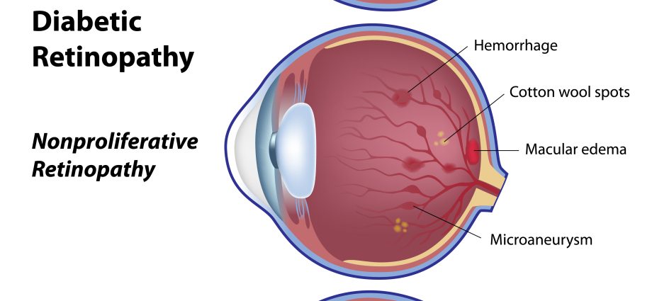 Does diabetes affect eyesight?