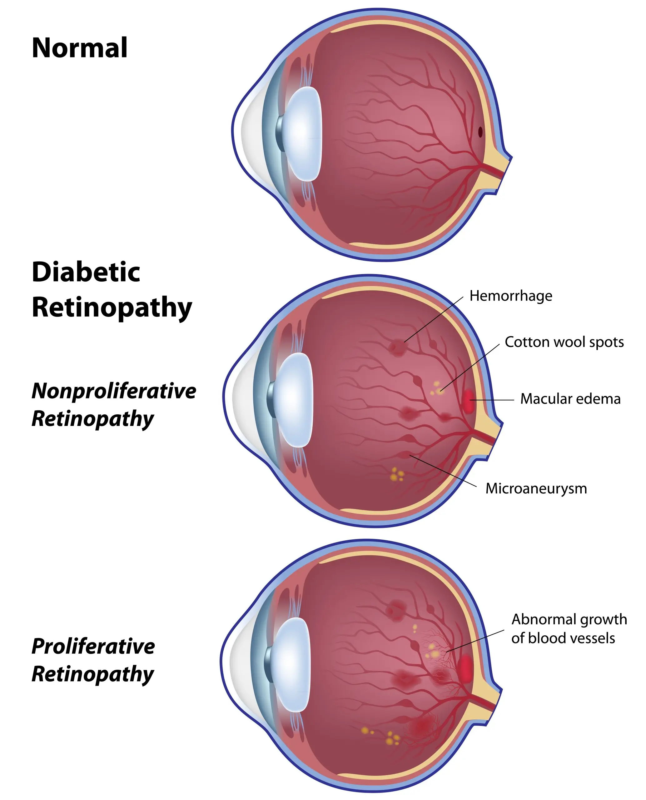 Does diabetes affect eyesight?