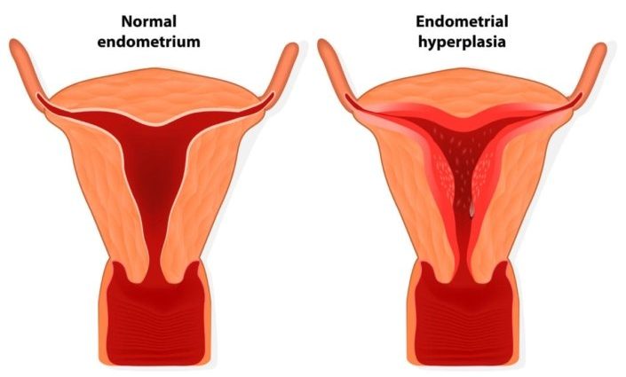 Does endometrial hyperplasia mean endometriosis?