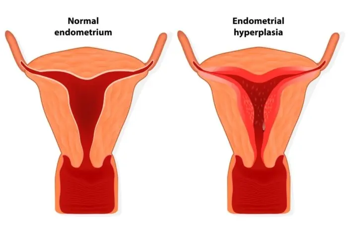 Does endometrial hyperplasia mean endometriosis?